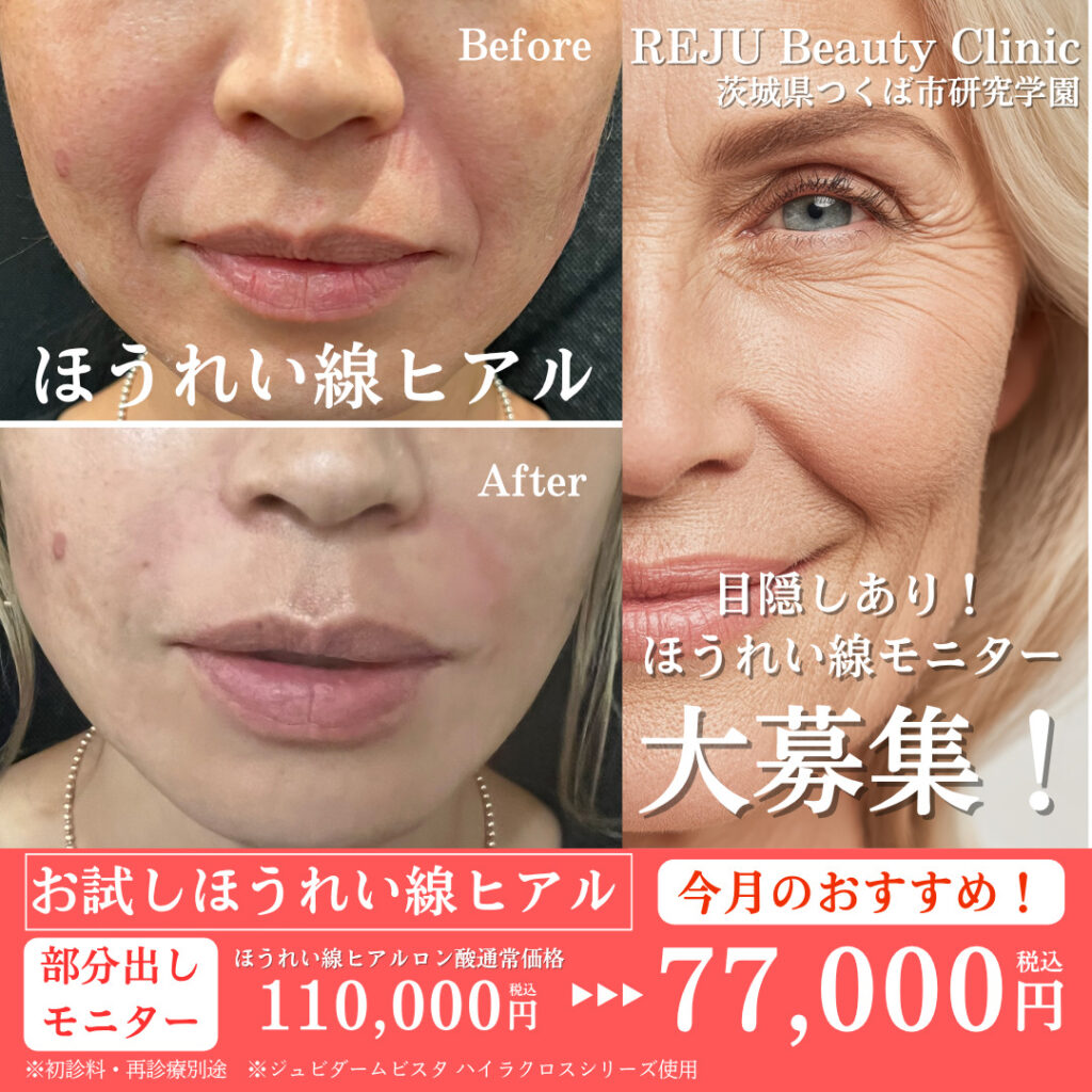 ほうれい線ヒアルロン酸モニター募集の紹介画像
