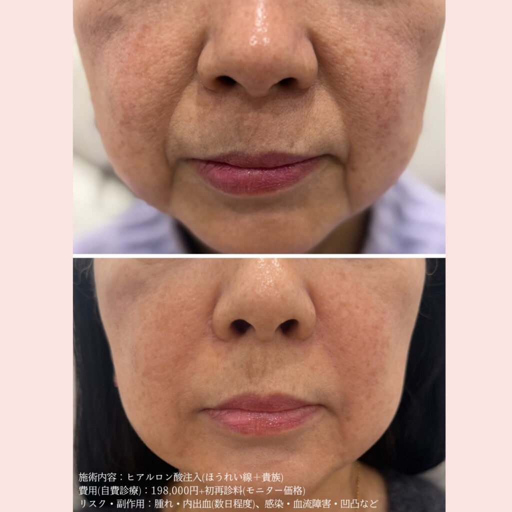 ほうれい線＋貴族ヒアルの症例写真
